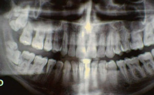 Les radios dentaires augmentent par trois le risque de tumeurs au cerveau