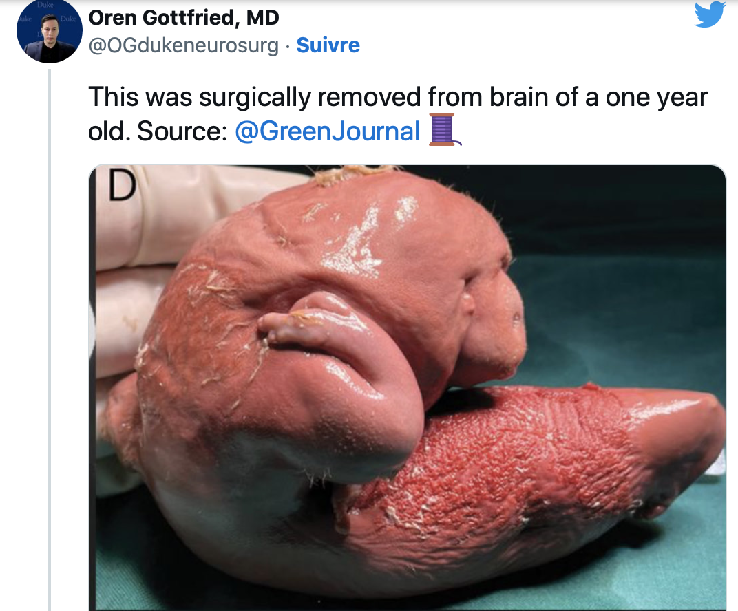 Le fœtus de son frère jumeau enlevé du cerveau d’une fillette d’un an