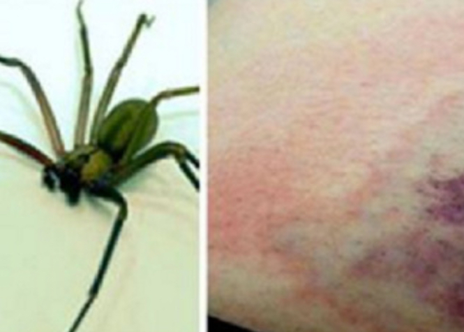 Vaucluse : Mordu par une araignée, un touriste échappe de peu à l’amputation