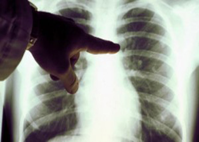 Le CHU de Nice a mis au point un test sanguin pour diagnostiquer en amont le cancer du poumon