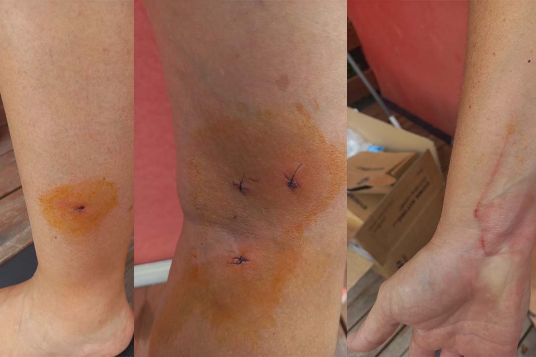 Morsures meute de chiens errants Etang Salé