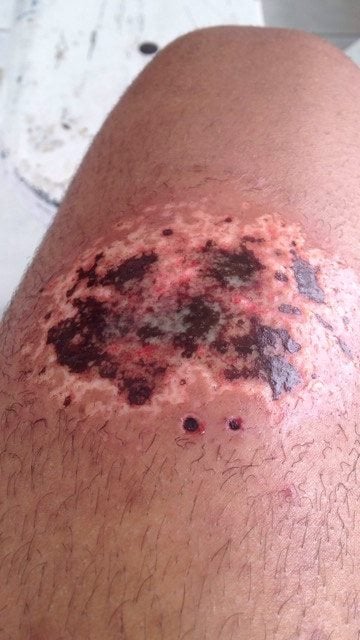 Un cuisinier se brûle à l'acide