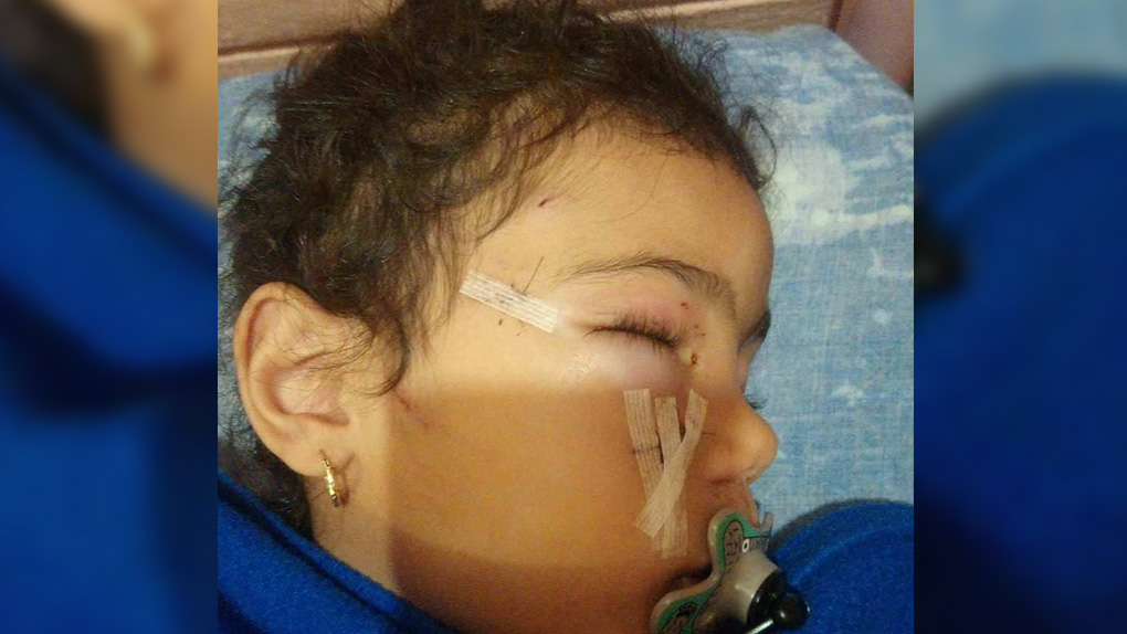 Sainte-Rose: Une fillette de 4 ans attaquée par un chien
