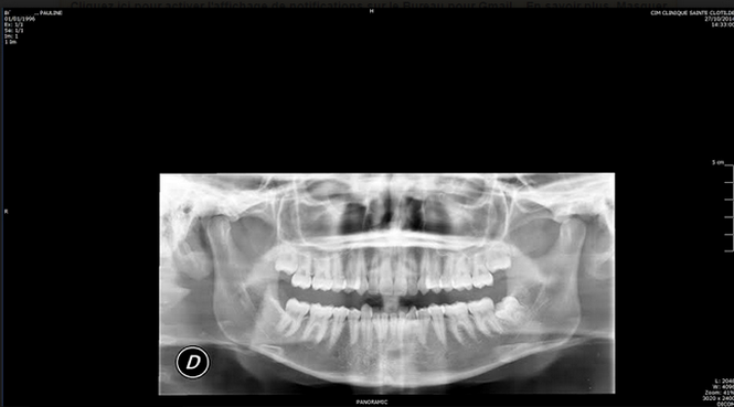 3 dents arrachées et une incision inutile: Pauline, victime d'une erreur de radio inversée